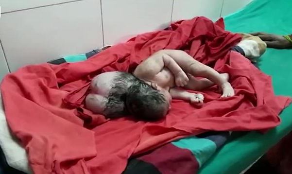 Un bébé est né avec trois têtes en Inde