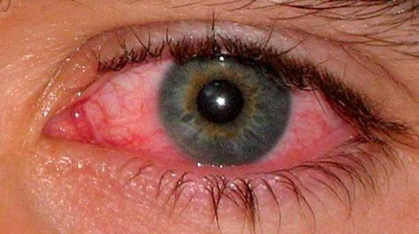 Le coronavirus pourrait persister dans les yeux des patients pendant des semaines, selon une étude
