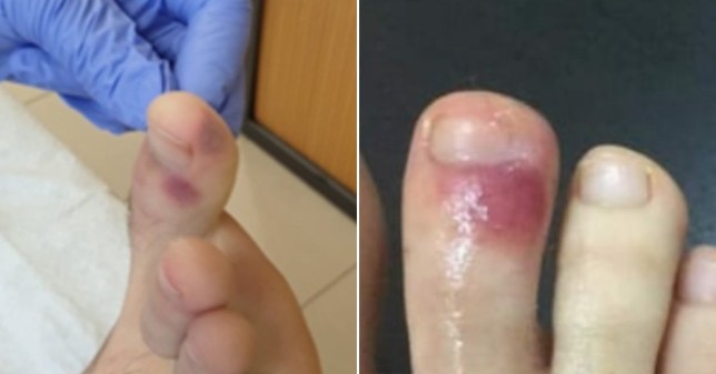 Des ecchymoses aux pieds « pourraient être le signe d&rsquo;un coronavirus », selon des médecins espagnols