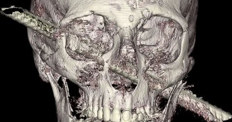 Miracle médical à Jérusalem: la chirurgie sauve un homme avec une barre de fer dans la tête